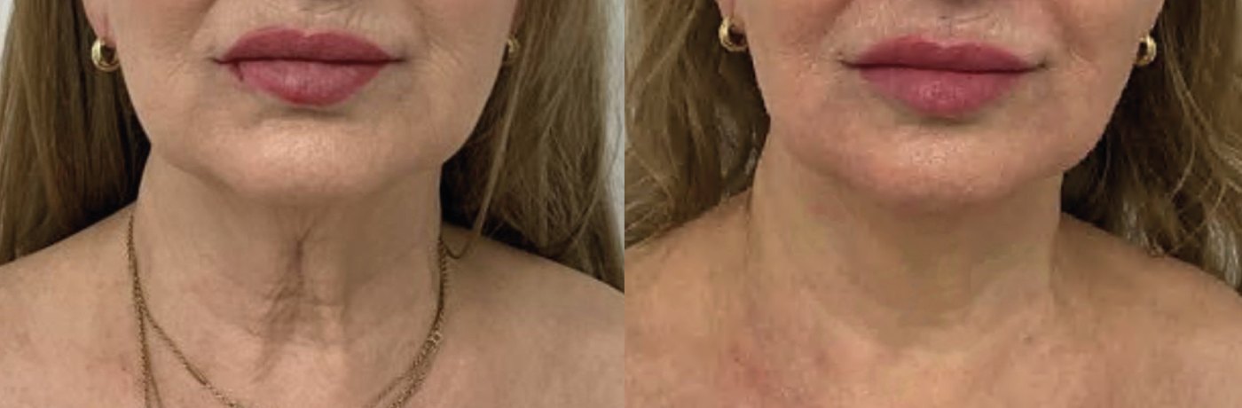 Antes e depois do tratamento de pescoço com Zaffiro