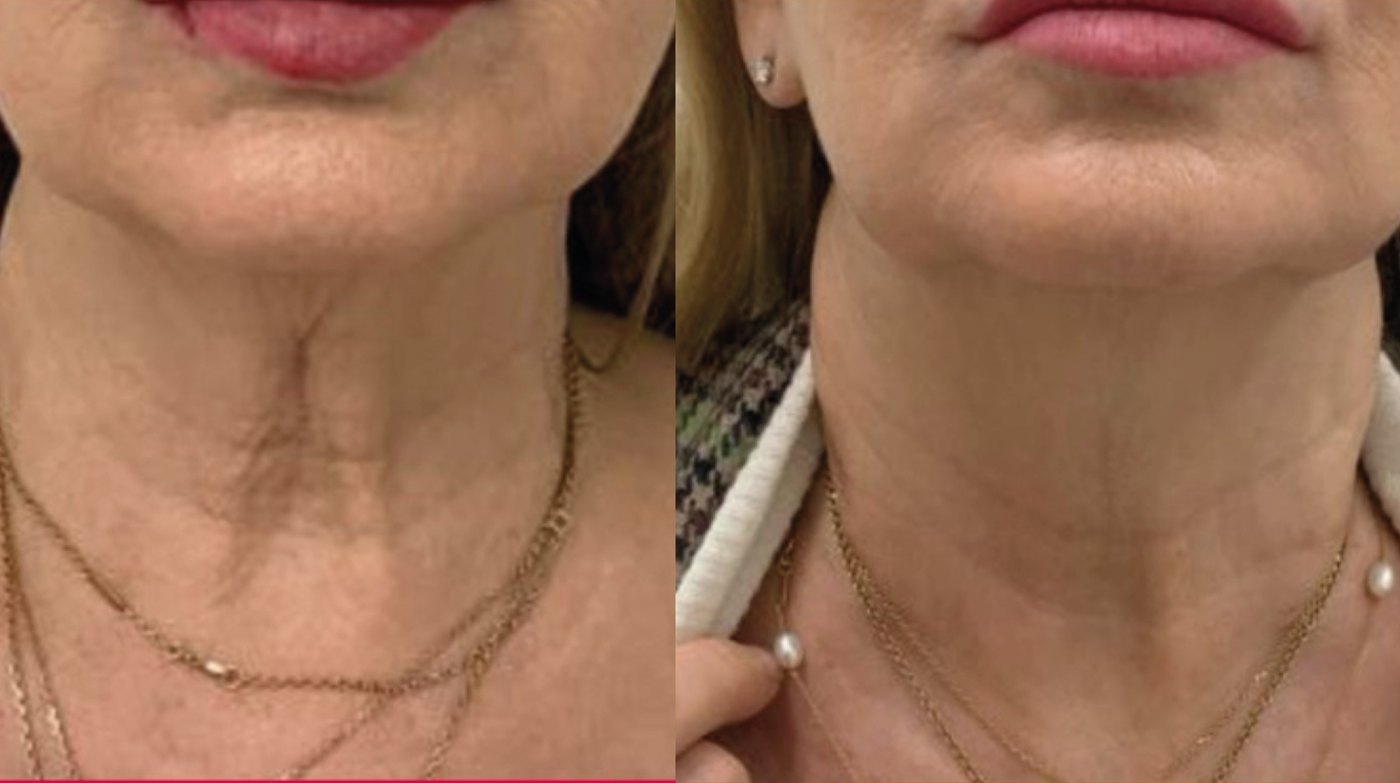 Antes e depois do tratamento de pescoço com Zaffiro