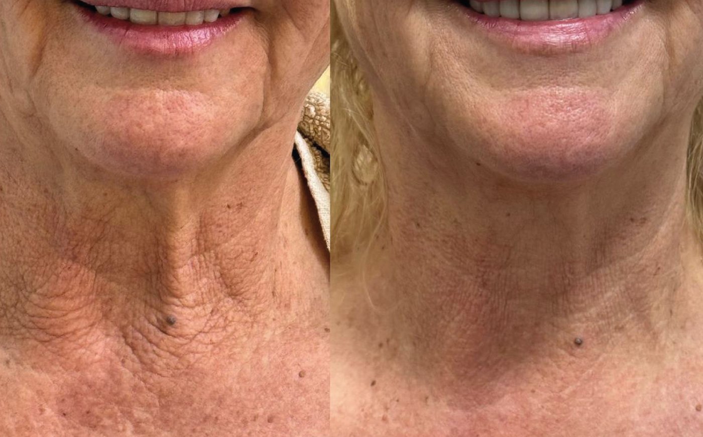 Antes e depois do tratamento de pescoço com Zaffiro