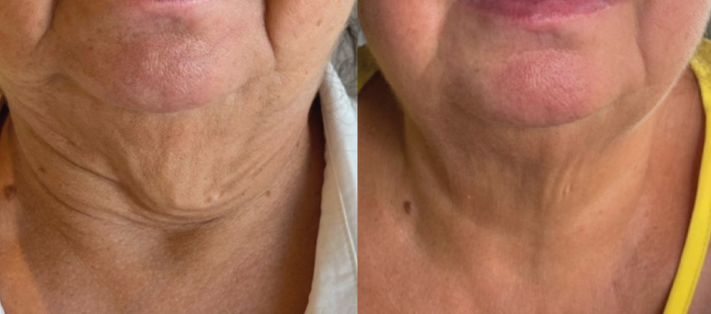 Antes e depois do tratamento de pescoço com Zaffiro